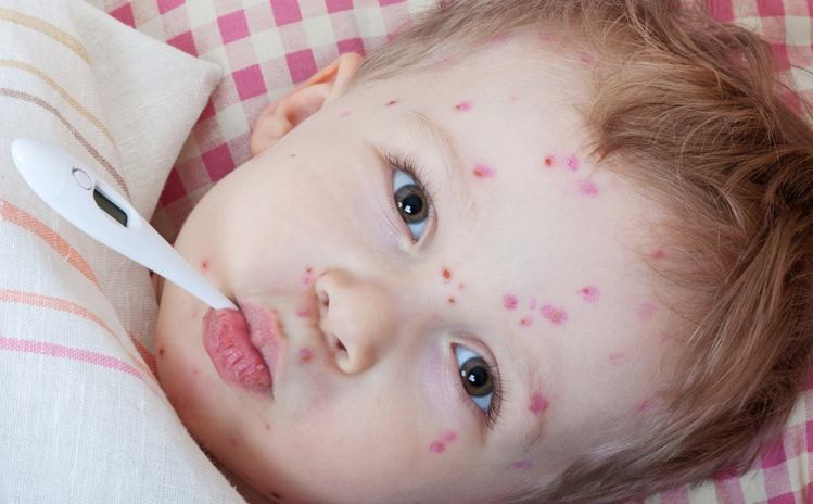 chickenpox vaccination for Indian children